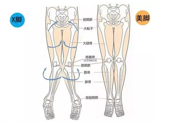 Ｘ型腿是什么腿型？