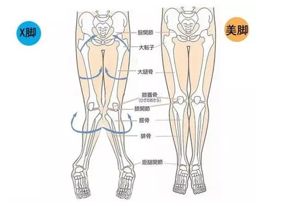 X型腿是什么腿型?